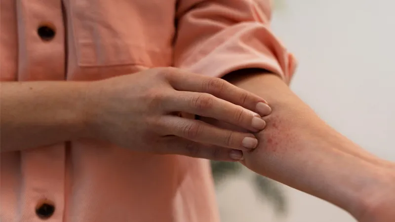 CBD Cream for Skin Rash: Does It Really Help?